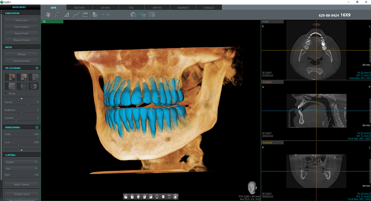 1. AI기술 특허 및 식약처 허가를 받은 이우소프트의 Quick Tooth Segmentation 영상.png